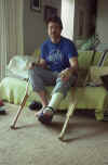 1985-015 Mt Shuksan May 1985 Me with Leg Cast.jpg (174036 bytes)